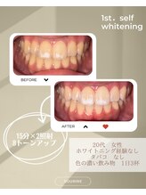 スリール(sourire)/ホワイトニング