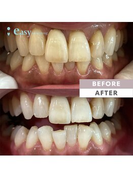 イージーホワイトニング 五反田店(easy whitening)/セルフホワイトニング症例写真