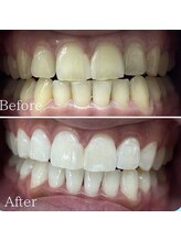 ホワイト 福岡天神店(WHITE)/６ヶ月継続ビフォーアフター