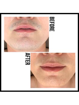 キビック(KIBIK)/【ヒゲ脱毛12回済】