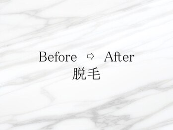 エスポワール(Espoir)/脱毛の実例♪