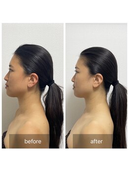 メロウゴールド(Mellow Gold)/ウィンバック3D小顔矯正リフト