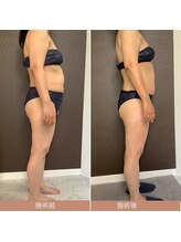 エスティーメル(ST mell)/キャビテーションハイパーナイフ