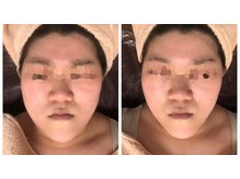 リボディ プラチナ(Rebody platinum)/小顔リフェイスコラーゲンリフト