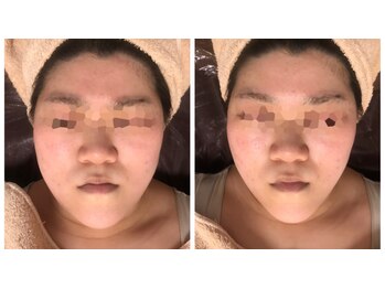 リボディ プラチナ(Rebody platinum)/小顔リフェイスコラーゲンリフト