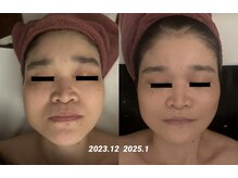ヴィクトワール シュエット/【フェイシャル】50代のお客様