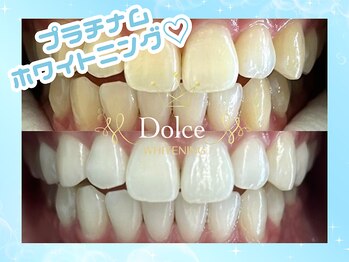 ドルチェ(Dolce)/ビフォーアフター
