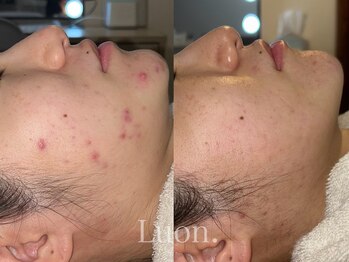 ルオン(Luon.)/ハーブピーリング/20代女性