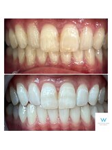 ホワイトニングショップ 奈良生駒店/周りに褒められる歯へ