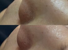 リアン 本町(Lien.)/毛穴の角質がごっそり！