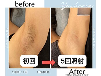 ユシェリア(Yucheria)/わきの経過写真