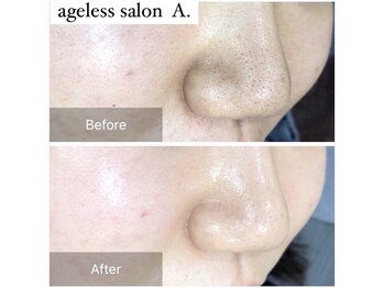 エードット(A.)/毛穴洗浄