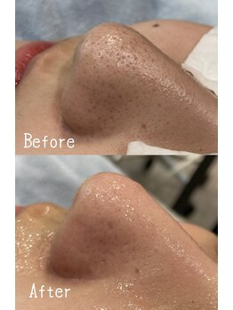 クレアトゥール/毛穴スキンクリアエステ