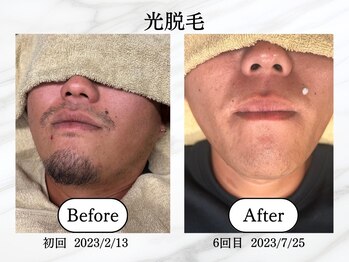 エスポワール(Espoir)/光脱毛で髭剃りいらず♪