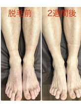 ビープラス(Biplus)/メンズ全身脱毛