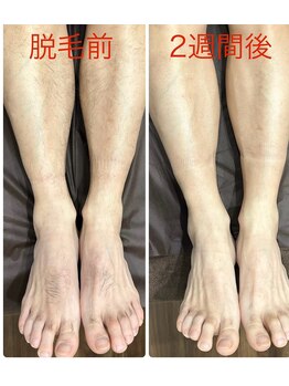 ビープラス(Biplus)/メンズ全身脱毛