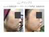 リピーター様用★剥離有ハーブピーリング&美肌浸透パック◎ ¥28000→27000