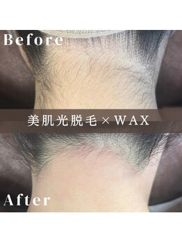 エピナ 横浜店(Epina)/うなじ脱毛/ブライダル脱毛