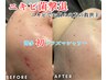 NEW☆【殺菌力抜群】ニキビケアに！プラズマシャワー＋美容液導入 全顔￥5900