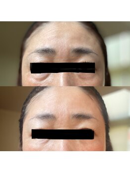 ウイユ(Oeil)/剥けるハーブピーリング 効果1回