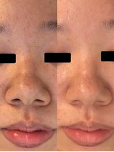 エステサロン 美飾り イオンモール木更津店/before⇒after/ハーブピーリング