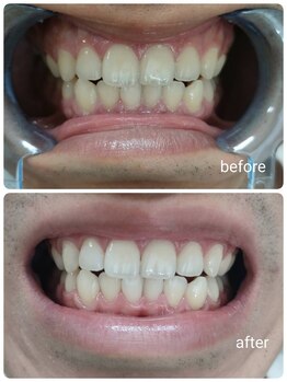 エクシアホワイトニング 盛岡中央通店/ビフォーアフター