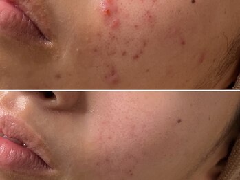 エイプリルフールズ(April fools)/【20代】凹凸改善◎滑らかな肌へ