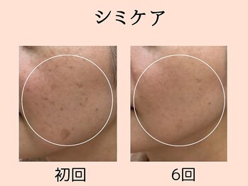 ウィズマツオカ 菊池本店/シミケア効果写真