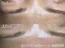 毛穴ケア+白玉ハーブで集中ケア