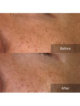 アート 熊本並木坂店(ART)/CSP/美白フラッシュコース/60分