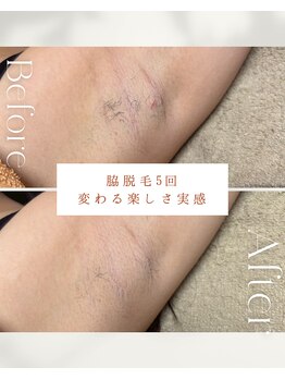 ビーエックス(.BX)/全身脱毛・ワキ脱毛・脇脱毛
