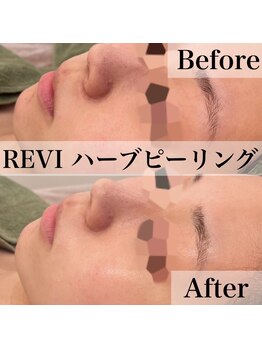 エステティックサロンR/毛穴の黒ずみ撃退!