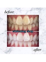 ホワイトニングショップ 岡山店/【岡山】美白ホワイトニング