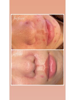 雅菜(miyabina)/毛穴　肌荒れ跡改善