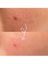 ひっそり美肌構築/ニキビ後の赤みも毛穴も改善♪