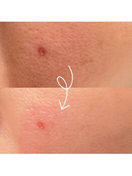 ひっそり美肌構築/ニキビ後の赤みも毛穴も改善♪