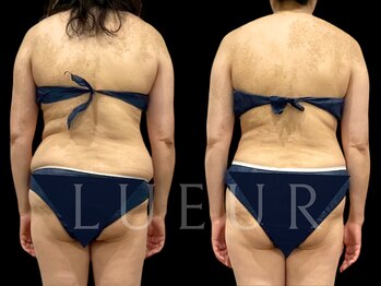 リュール北千住(LUEUR)/背中施術事例