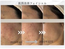 エステティックサロン シーズの雰囲気(#肌荒れ #敏感 #ニキビ #にきび #水素ケア)