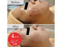 リエル(Liel)の雰囲気(【繰り返す肌荒れに】医師監修エクソソーム導入でニキビ肌改善!)