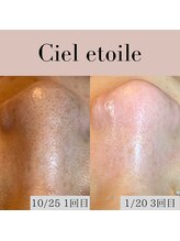 シエルエトワレ/毛穴エクストラクション