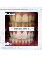 ホワイトニングショップ 豊田店(WHITENING SHOP)/5回来店でこの白さ!!