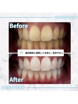 ホワイトニングショップ 豊田店(WHITENING SHOP)/5回来店でこの白さ!!
