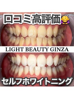 ライトビューティー 銀座店(LightBeauty)/東銀座 ホワイトニング 症例写真