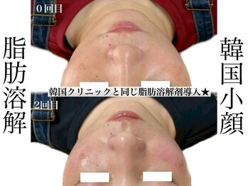 リベルキョウト 京都駅前店(Liber Kyoto)/レモンボトル超え!二重顎撃退