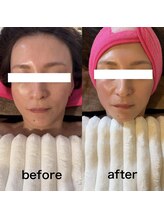 サロン ニコリー(Salon Nicolly)/ボニックス1回施術前後