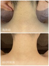 ミラ(Mila)/うなじ脱毛！5回施術後の変化♪