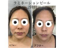 ダオン(DAON)/ラミネーションピール