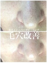リリアーナ(LILIANA)/ハーブピーリングで毛穴ケア