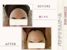 アロマ ソメイエ(Aroma Sommeiller)/バクテリウムピール★健康肌へ♪