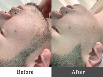 メンズオージー 岡山中区(men's O.G)/メンズ脱毛|ひげ脱毛